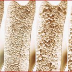 Osteoporose Symptome Ursachen Und Behandlung