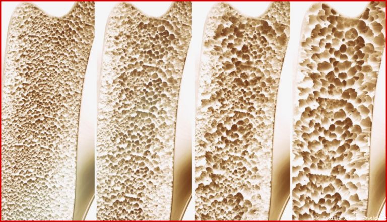Osteoporose Symptome Ursachen Und Behandlung