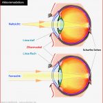 Ursache Von Altersweitsichtigkeit